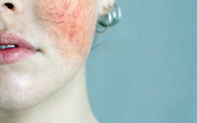 Rosácea y Alimentación: ¿Por qué tu Dieta es la Clave Para una Piel sin Rojeces?