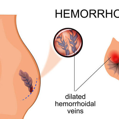Hemorroides