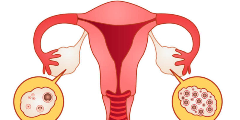 Ovario Poliquístico