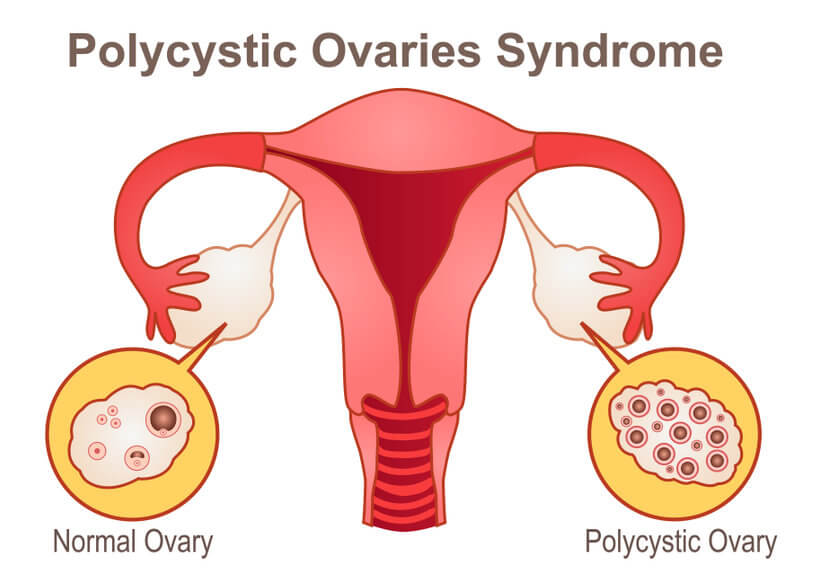 Ovario Poliquístico
