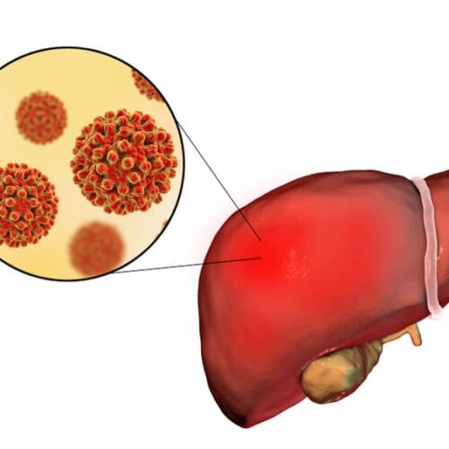 hepatitis crónica
