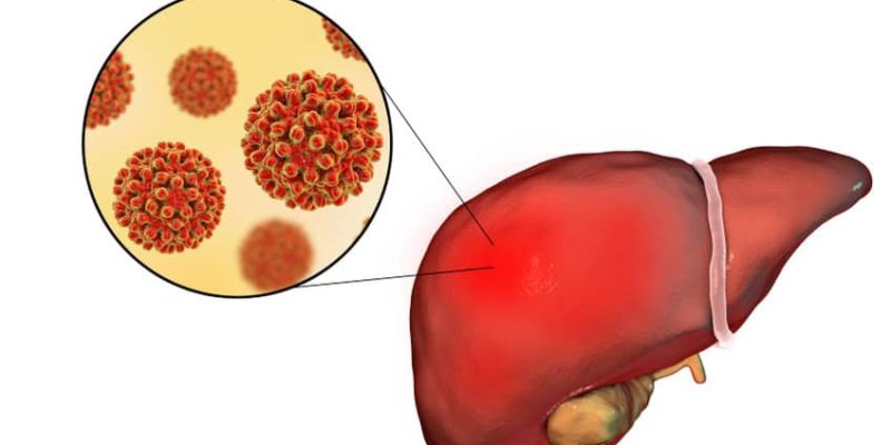 hepatitis crónica