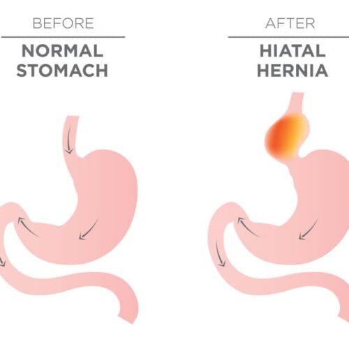hernia de hiato