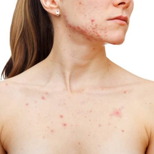 acne y alimentación
